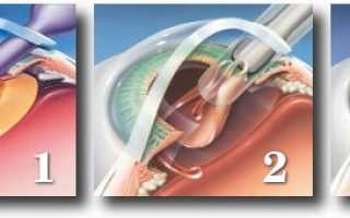 Как проводится операция по удалению катаракты с заменой хрусталика глаза