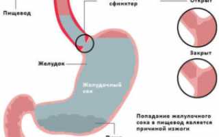 Причины изжоги и последствия