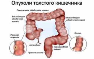 Лечение кишечной непроходимости