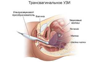 Ультразвуковое исследование беременной в первом триместре