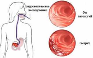 Поверхностный гастрит