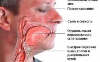 Применение Дексаметазона при лечении аллергии, возможность аллергической реакции на препарат