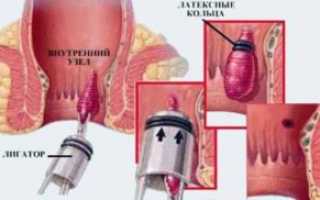 Чем и как лечить геморрой женщинам