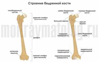 Перелом бедренной кости: классификация и виды перелома, лечение и их последствия