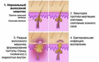 Причины и симптомы себореи, избавление от перхоти, зуда, шелушения кожи головы