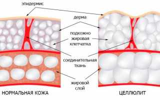 Целлюлит: общая информация о причинах, формах и методах лечения