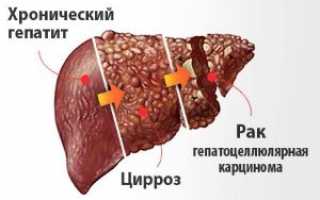 Симптомы и лечение воспаления печени у женщин и мужчин