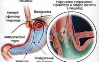 Эзофагит дистальный