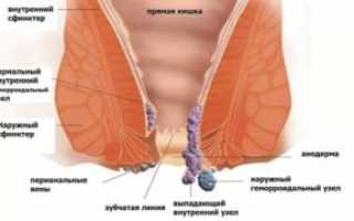 Свечи от внешнего геморроя