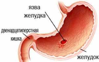 Ренни при признаках изжоги