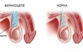 Варикоцеле – что это, причины, диагностика и терапия заболевания