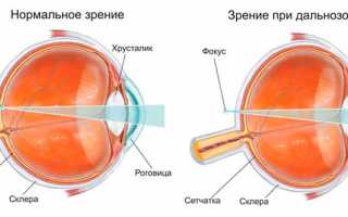Коррекция дальнозоркости: восстановление зрения в домашних условиях