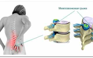 Как определить межпозвоночную грыжу