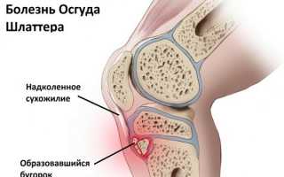 Хрящи коленного сустава разрушает не только артроз