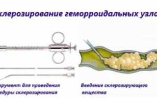 Удаление узлов при геморрое