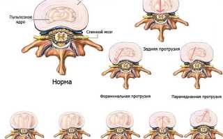 В стадии протрузии грыжу можно обратить вспять