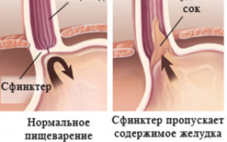 Эффективность Но-шпы при изжоге