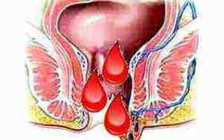 Кровь при геморрое, что делать