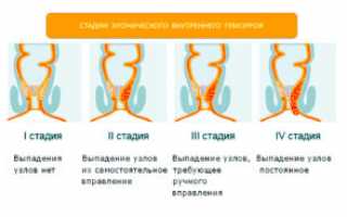 Лечение геморроя эффективными средствами народной медицины