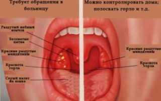 Боли в горле после гастроскопии, что делать