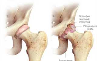 Когда необходима замена тазобедренного сустава?