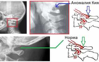 Какие бывают пороки развития шейного отдела