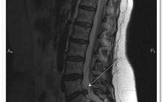 Лечение межпозвоночной грыжи крестцового отдела
