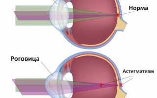 Отличия дальнозоркости, близорукости и астигматизма