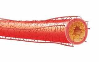 Атеросклероз сердца: лечение, причины и симптомы заболевания