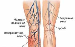 Основные методики лечения тромбофлебита различной этиологии