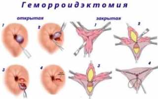 Чем можно лечить геморройные узлы