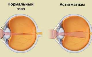 Основные методы лечения астигматизма