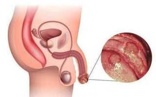 Способы профилактики молочницы у мужчин