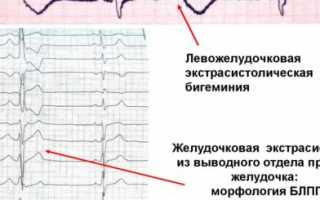 Архивы Экстрасистолия – HeartInfo