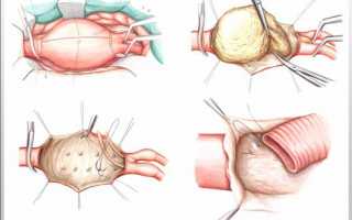 Аневризма брюшной части аорты: причины возникновения, симптомы и лечение
