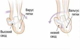 Варусная стопа: О-образные ноги и нарушенная биомеханика