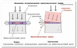 Безоперационное лечение межпозвоночной грыжи