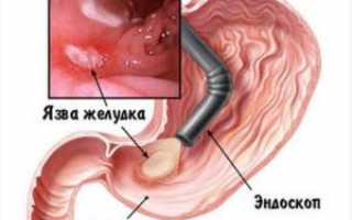 Признаки гастрита и язвы желудка, отличия