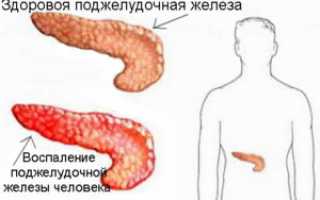 Диета при панкреатите и язве 12-перстной кишки
