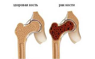 Компьютерная томография при отклонениях в тазовых костях