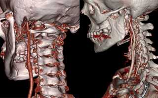 Как обследуют брахицефальные артерии с помощью КТ