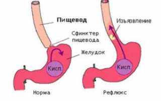 Симптомы рефлюкс-эзофагита и лечение