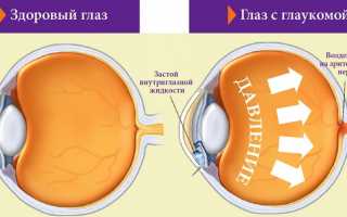 Чем отличается катаракта от глаукомы