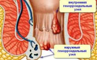 Геморрой комбинированный