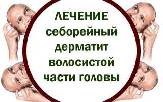 Лечение себорейного дерматита волосистой части головы