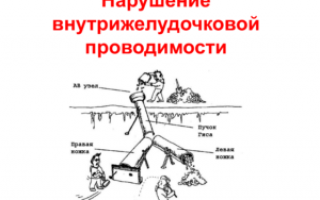 Нарушение внутрижелудочковой проводимости сердца: симптомы, диагностика, лечение