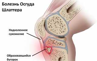 Болезнь Шляттера — что нужно знать и как лечить