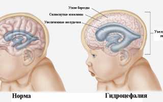 Нарушения внутричерепного давления у ребенка: причины, диагностика и лечение