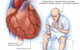 Острая и хроническая сердечная недостаточность: принципы лечения