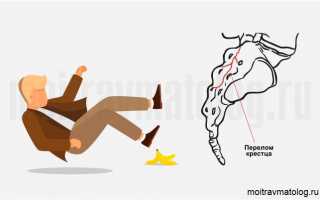 Перелом крестца, лечение и последствия
